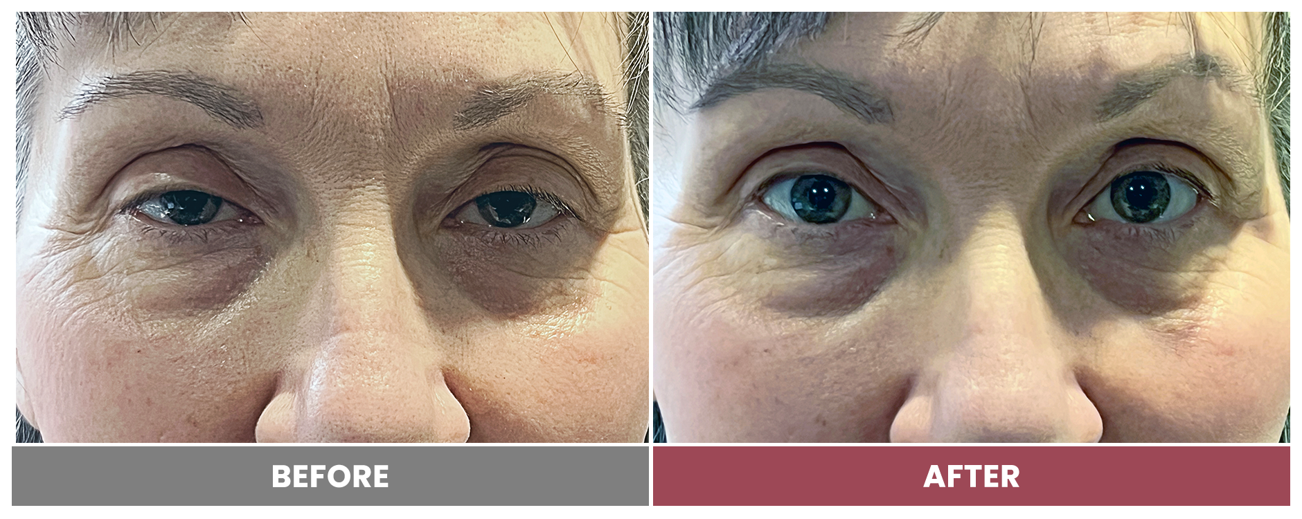 PTOSIS REPAIR - Case 69